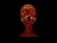 Hatiay (mummy 23), a male Egyptian scribe aged 40–50 years, who lived during the New Kingdom (1570–1293 BCE) and was found near modern day Luxor. This CT image shows that he was suffering from carotid calcification.